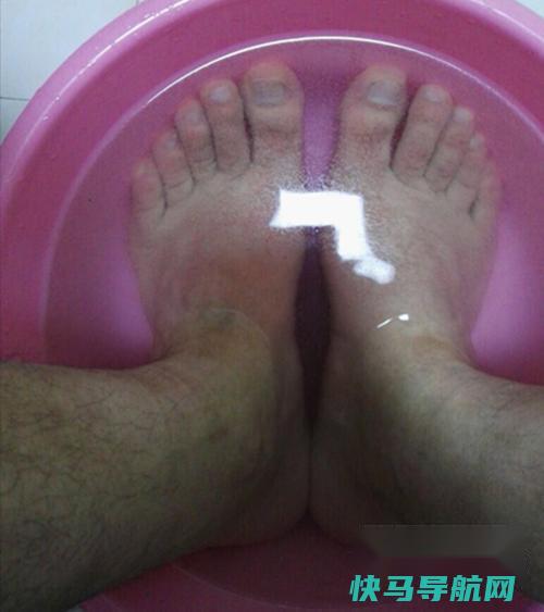 脚气和灰指甲怎么根治？用白醋和醋精就可以根治